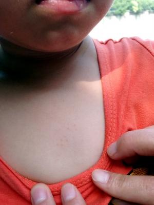 4岁女童胸口被扎10个针眼 疑是幼儿园老师扎的