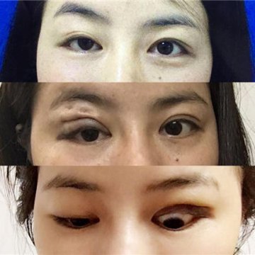 深圳女子2.6万做眼部整形 术后变大小眼